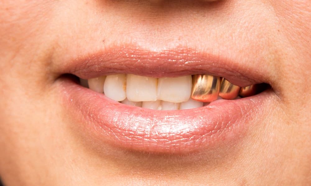 How to Get Gold Teeth? Beast Beauty